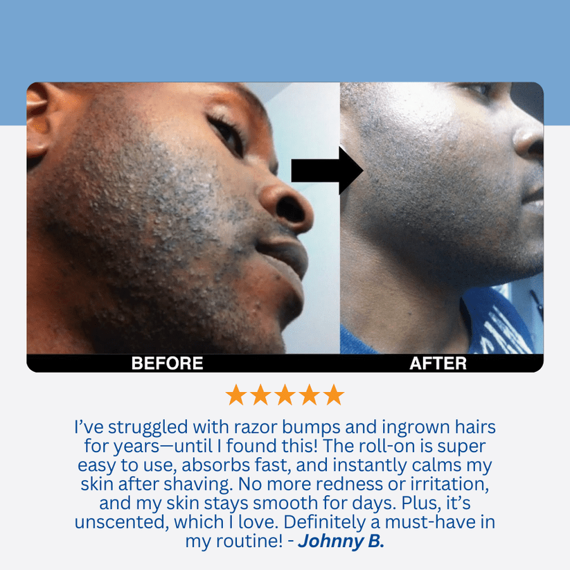 LUHAKA® Razor Bump & Ingrown Hair Treatment