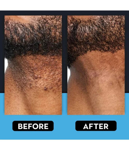 LUHAKA® Razor Bump & Ingrown Hair Treatment