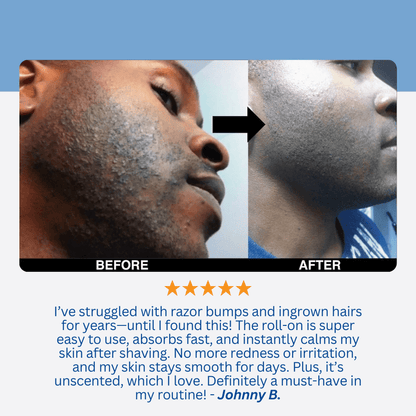 LUHAKA® Razor Bump & Ingrown Hair Treatment